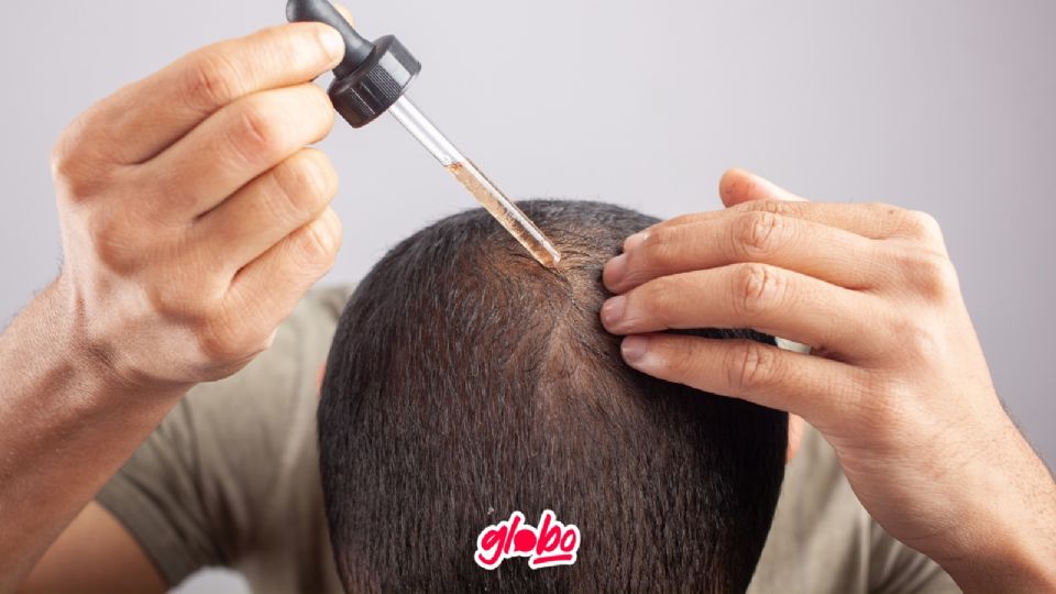 Minoxidil es uno de los productos más utilizado en el mundo de la calvicie.