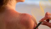 ¿Por qué se produce el cáncer de piel y cuáles son sus síntomas? Así puedes prevenirte de los rayos solares